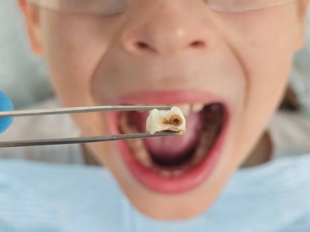 Best Emergency Tooth Extraction in Halls, TN