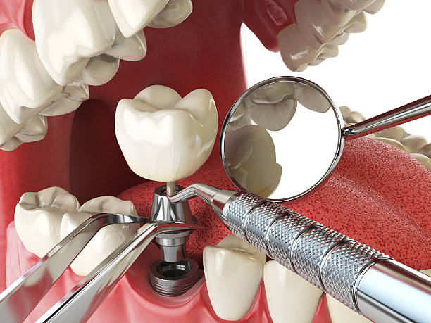 Best Emergency Wisdom Teeth Removal in Halls, TN
